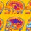 Brain scans put more extreme ADHD in focus